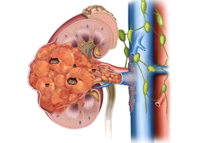 Partial and Radical Nephrectomy