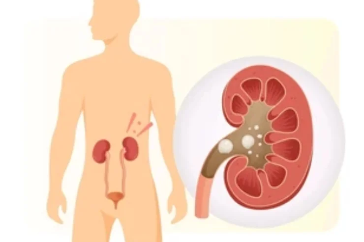 Percutaneous Nephrolithotomy (PCNL)---0