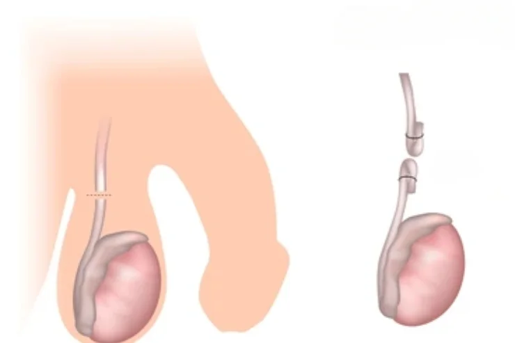 Vasectomy and Vasovasostomy